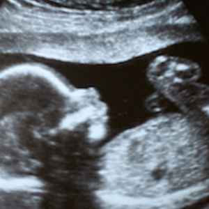 Baby  Number Three