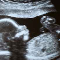 Baby  Number Three